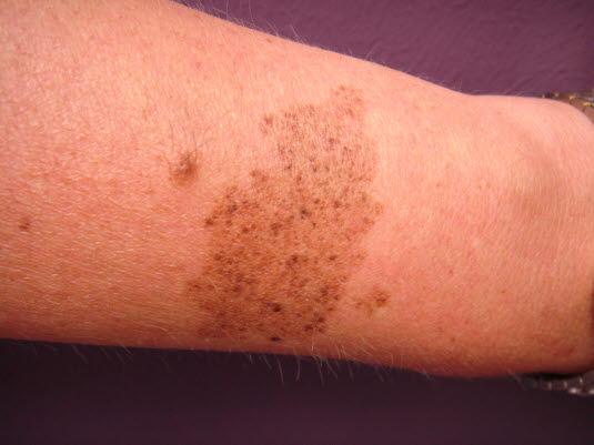 Nevus, kongenitt (spileus) Nevus, kongenitt (spileus)