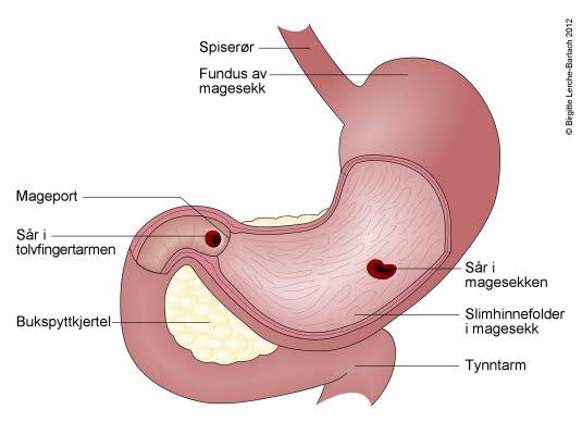 Magesekk med magesår Magesekk med magesår