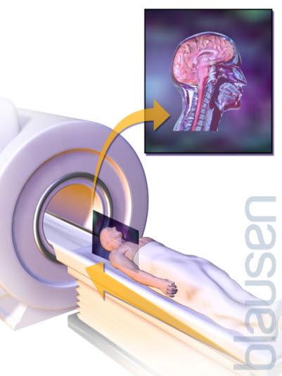 MR av hjerne MR av hjerne