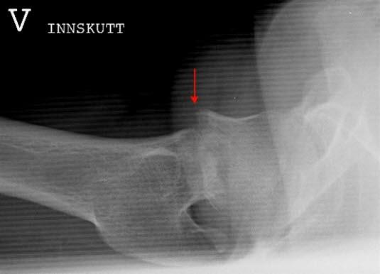 Lårhalsbrudd, innkilt Lårhalsbrudd, innkilt