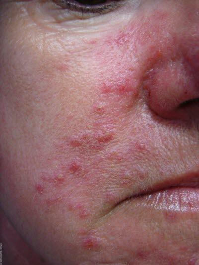 Rosacea Rosacea