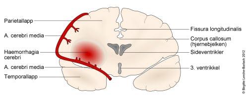 9945-2-481-intracerebral-blodning.jpg 9945-2-481-intracerebral-blodning.jpg