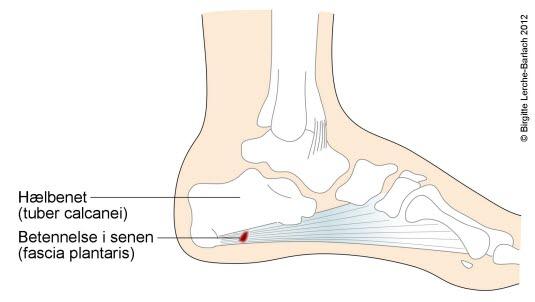 Tendinitt 2 Tendinitt 2