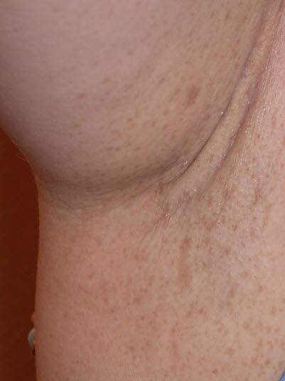 Nevrofibromatose, fregner i armhulen Nevrofibromatose, fregner i armhulen