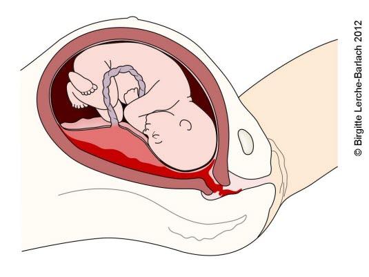 Morkakeløsning Morkakeløsning