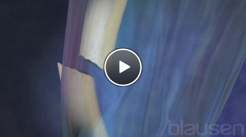 beinbrudd2 beinbrudd2