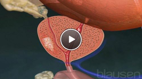prostatakreft prostatakreft