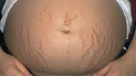 Strekkmerker Strekkmerker