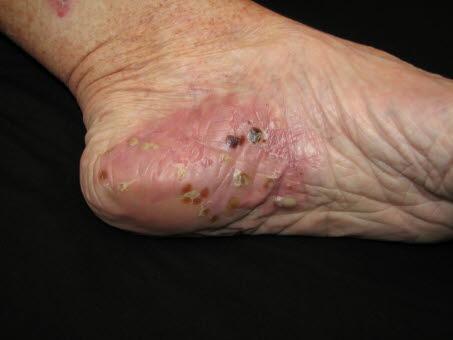 4966-2-pustulosis-palmoplantaris-2.jpg 4966-2-pustulosis-palmoplantaris-2.jpg
