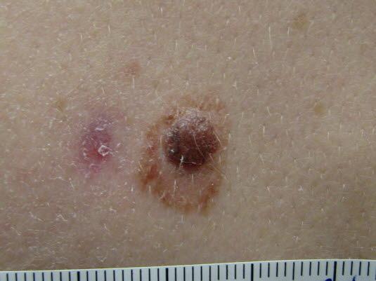 Nevus, atypisk Nevus, atypisk