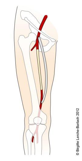 Bypass-operert arterie Bypass-operert arterie