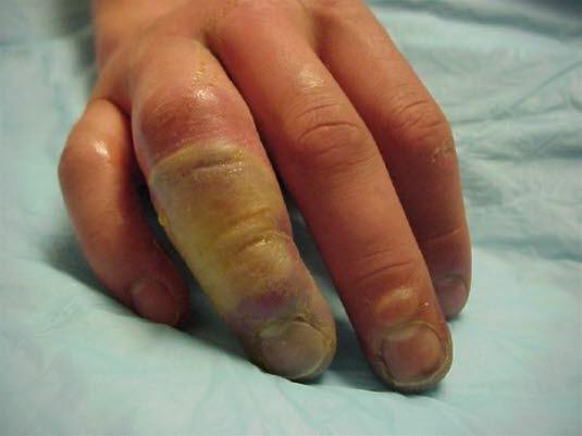 Frostskade Frostskade