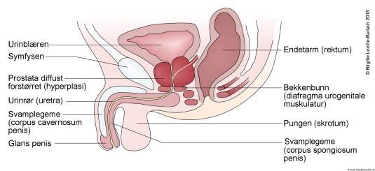 Benign prostatahyperplasi bilde#1 Benign prostatahyperplasi bilde#1