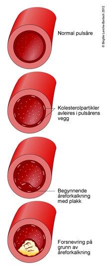 Utvikling av aterosklerose Utvikling av aterosklerose