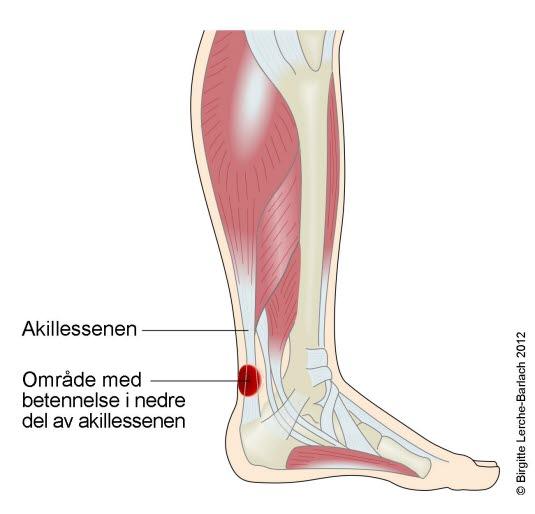 Akillessenebetennelse Akillessenebetennelse