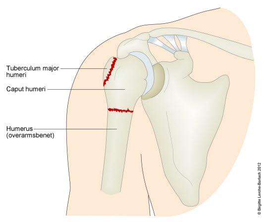 fraktur humerus caput fraktur humerus caput