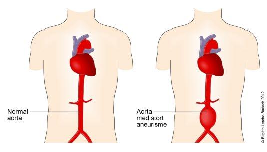 Abdominalt aorta aneurisme Abdominalt aorta aneurisme