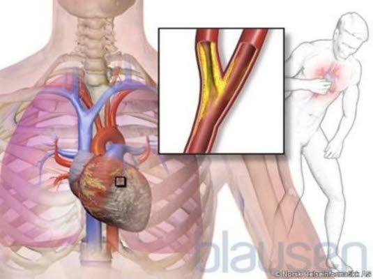 Angina pectoris Angina pectoris