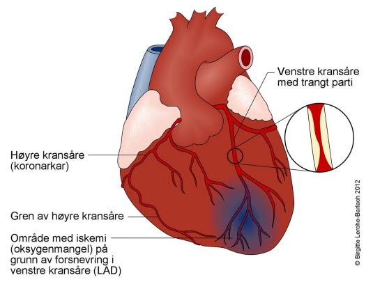 Hjerte med angina