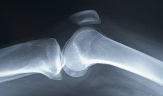 Lårbeinet og leggbeinet Lårbeinet og leggbeinet