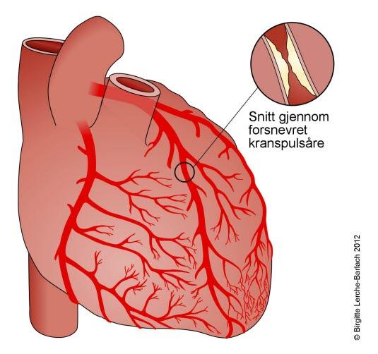 Innsnevring i koronararterie Innsnevring i koronararterie