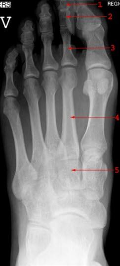 Røntgen av normal fot Røntgen av normal fot