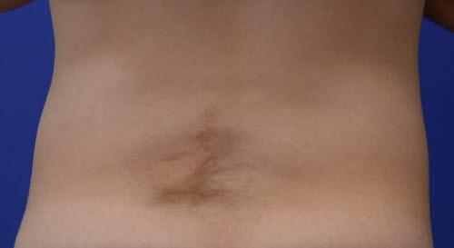 47333-2-spina-bifida-occulta-hartegn.jpg 47333-2-spina-bifida-occulta-hartegn.jpg