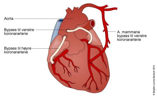 Koronar trippel bypass Koronar trippel bypass