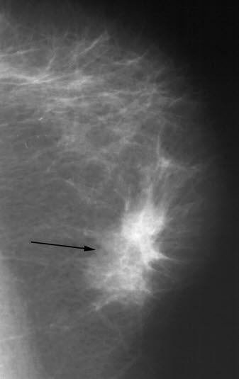 Mammografi, cancer Mammografi, cancer