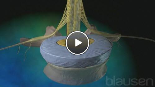 slitasje i mellomvirvelskivene slitasje i mellomvirvelskivene