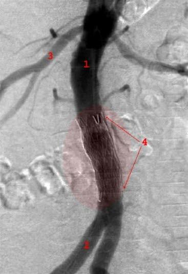 Aorta stentgraft Aorta stentgraft