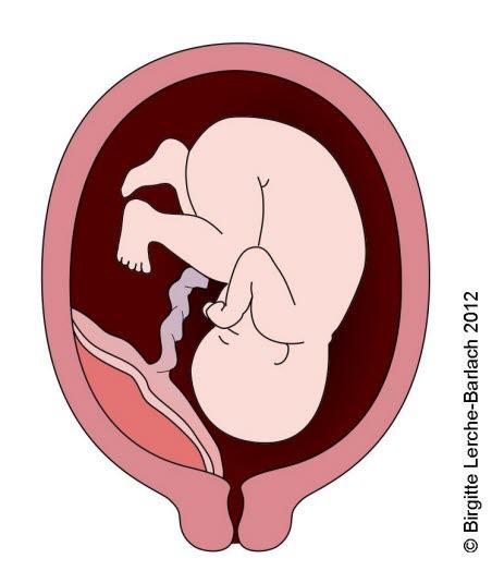 Placenta - bakre vegg Placenta - bakre vegg