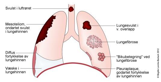 Ulike sykdommer i lungene Ulike sykdommer i lungene