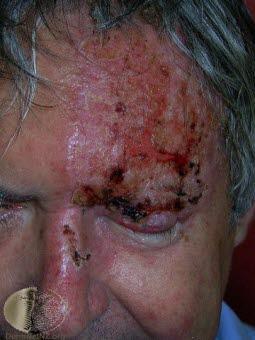 Zoster oftalmicus Zoster oftalmicus