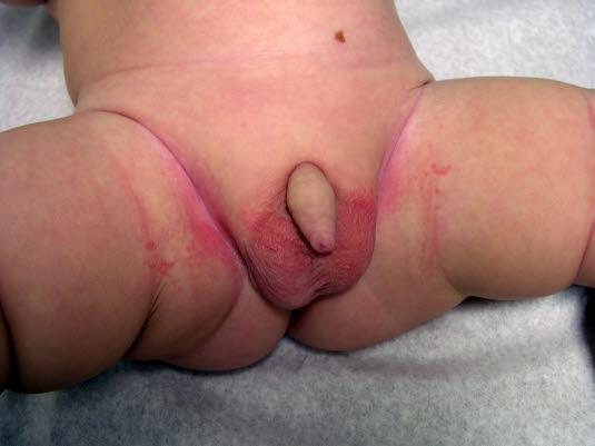 Bleiedermatitt med sopp Bleiedermatitt med sopp