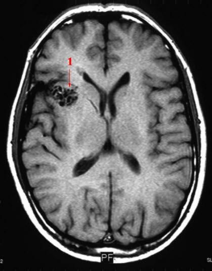 AV-malformasjon (MR) AV-malformasjon (MR)