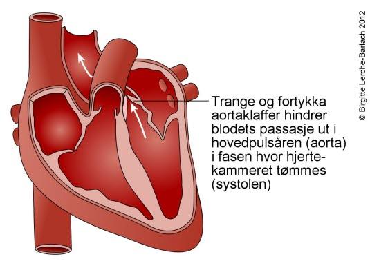 Aortastenose, klaffefeil Aortastenose, klaffefeil