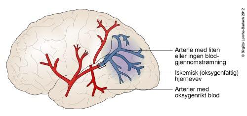 9939-2-hjerneinfarkt.jpg 9939-2-hjerneinfarkt.jpg