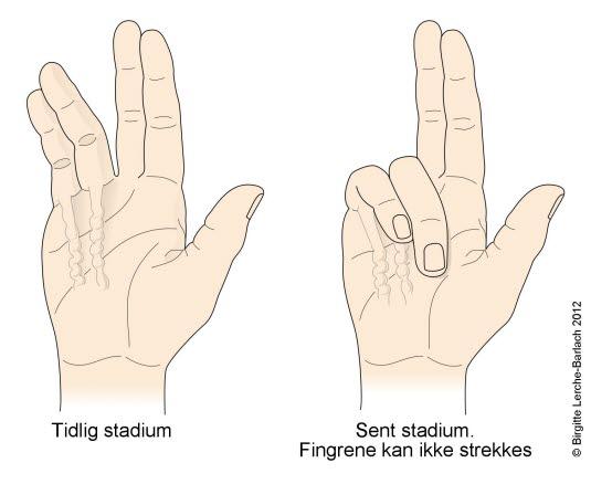 Dupuytrens kontraktur Dupuytrens kontraktur