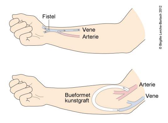 Dialysefistler Dialysefistler