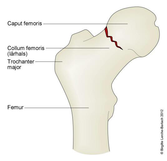 Lårhalsbrudd, innkilt Lårhalsbrudd, innkilt
