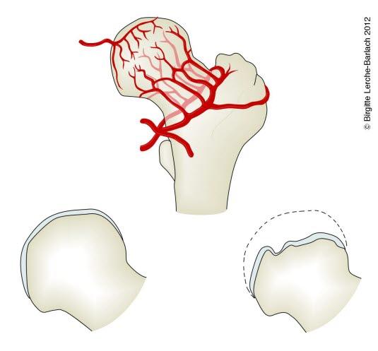 Caput femoris, blodforsyning Caput femoris, blodforsyning