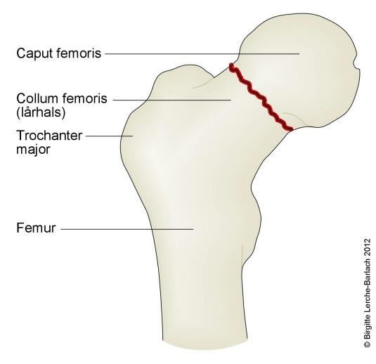 Lårhalsbrudd, ingen forskyvning Lårhalsbrudd, ingen forskyvning