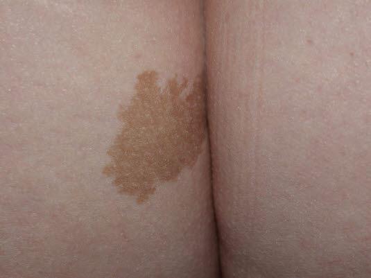 Nevrofibromatose, café a lait flekk Nevrofibromatose, café a lait flekk