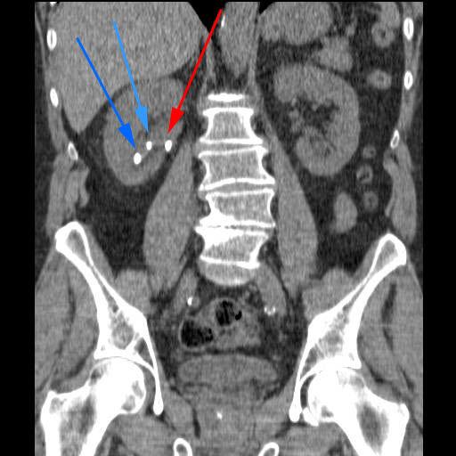 Nyresten påvist ved CT Nyresten påvist ved CT