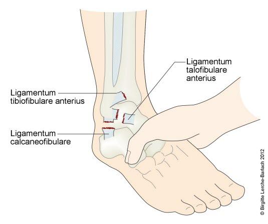 Ankel, overrevne leddbånd Ankel, overrevne leddbånd