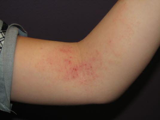 atopisk eksem, barn antecubital fossa atopisk eksem, barn antecubital fossa