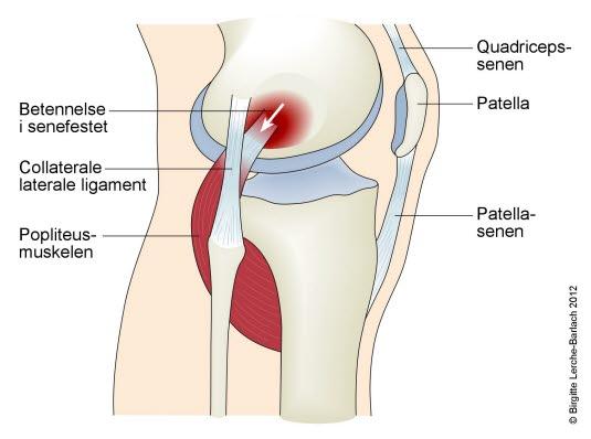 Kne, popliteustendinopati Kne, popliteustendinopati