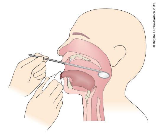 Speilundersøkelse av nedre del av svelget. Speilundersøkelse av nedre del av svelget.