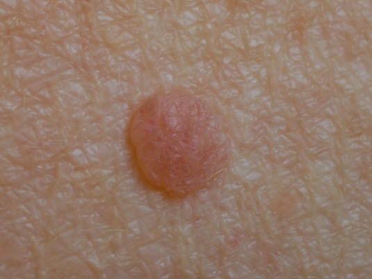 Nevus, dermal (hos eldre) Nevus, dermal (hos eldre)